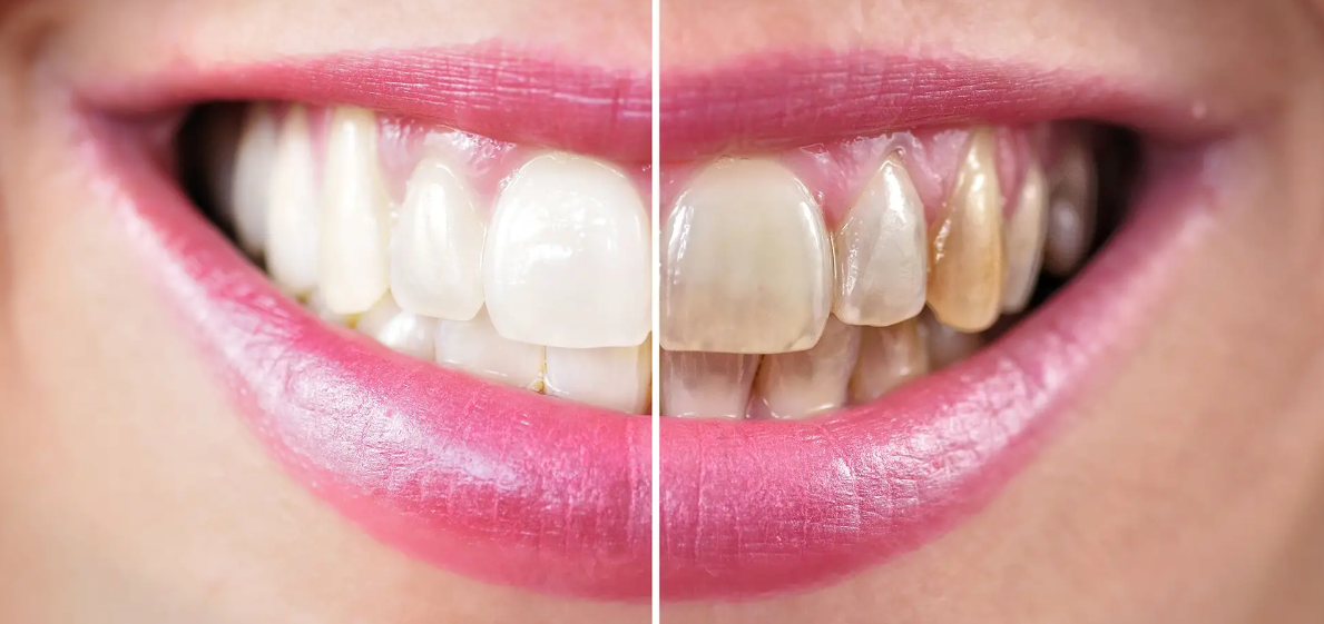 Teeth whitening on Gold Coast