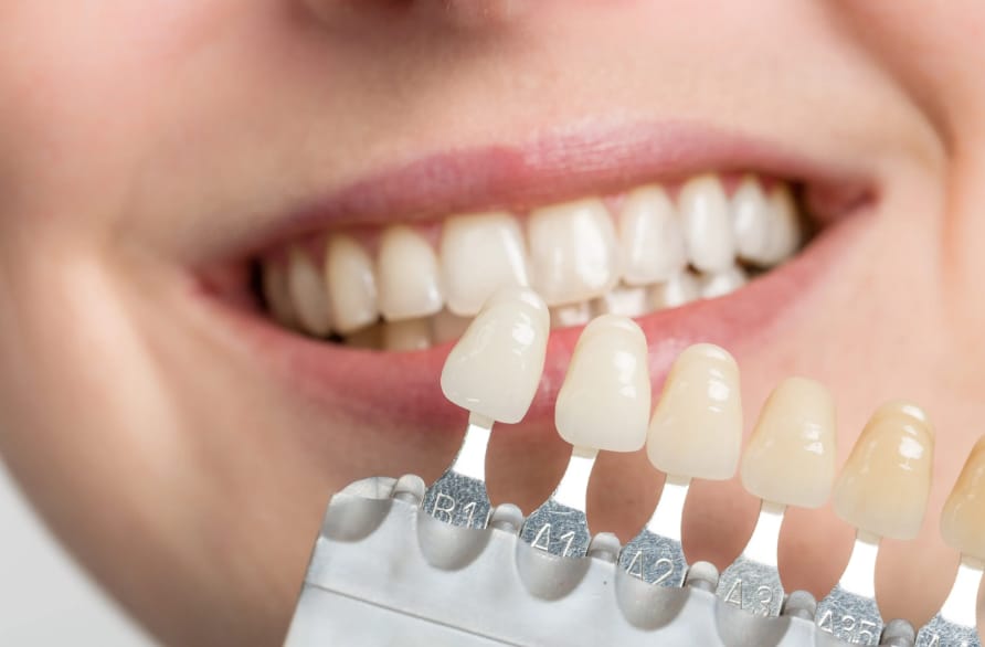 teeth veneers on the Gold Coast