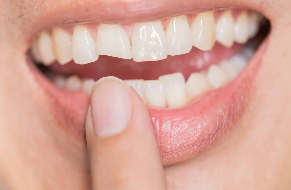 Dental crowns in Gold Coast